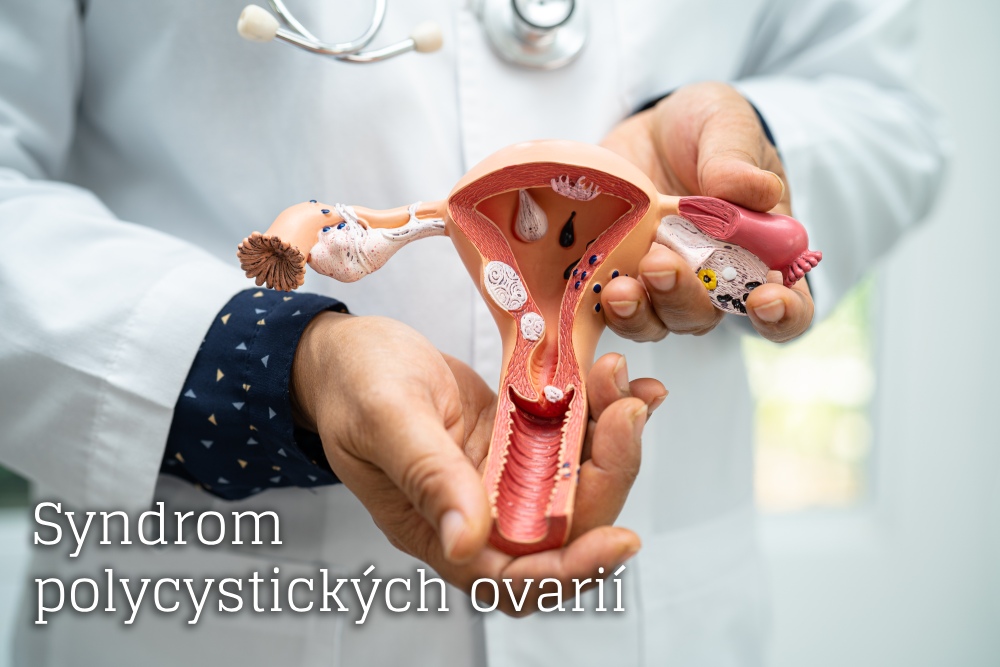 syndrom polycystických ovarií